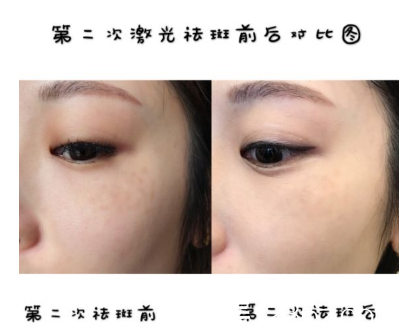 坐標(biāo)山東，飛韓國(guó)童顏中心做的激光祛斑+皮膚護(hù)理，我覺得我沒有選擇好，其實(shí)我自己還真的蠻好奇我的恢復(fù)效果的