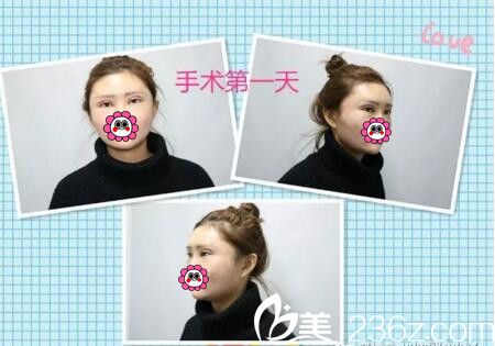 整形手術(shù)術(shù)后天