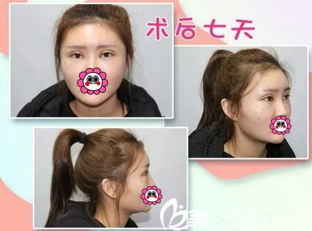 雙眼皮填充術(shù)后一周