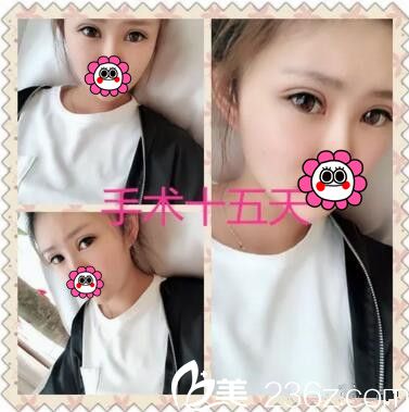 面部脂肪填充雙眼皮術(shù)后半個月<span style=