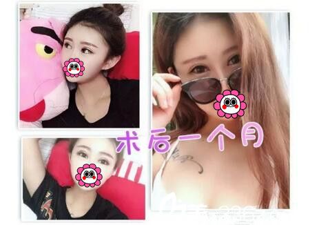 面部脂肪填充+雙眼皮術(shù)后一個月<span style=