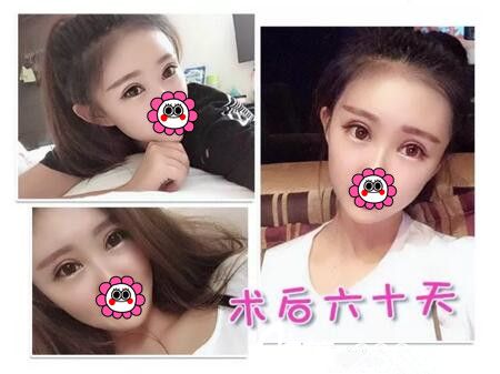 分享我在海南韓美做自體脂肪填充面部+眼綜合術后兩個月恢復效果圖