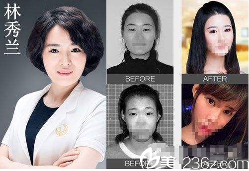 林秀蘭醫(yī)生眼部整形案例