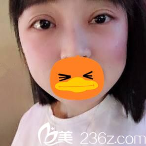 割雙眼皮+開(kāi)眼角術(shù)后20天恢復(fù)程度