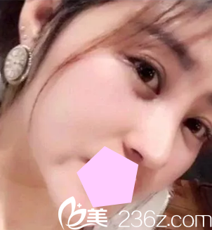 看了網(wǎng)上隆鼻價(jià)格后，我選擇在大同美神整形做鼻綜合隆鼻，展示前后對(duì)比照片