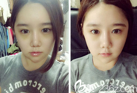 下巴看著還是有點歪歪的