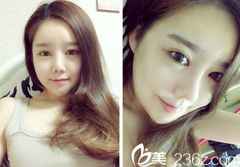 下巴終于順眼了，下頜角都沒有了