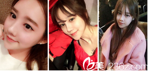 一起挑刺吧！韓國(guó)巴諾巴奇整形醫(yī)院輪廓手術(shù)（下頜角+顴骨+下巴）案例分析，這家醫(yī)院其實(shí)在韓國(guó)的度高一點(diǎn)