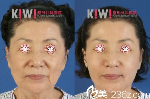 金智勛面部提升案例