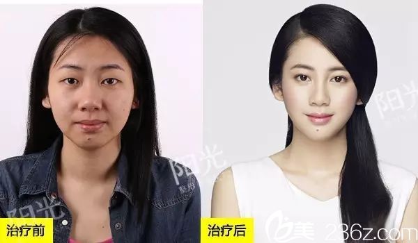 <!--<i data=20240703-sp></i>-->整形醫(yī)院雙眼皮整形案例圖 <!--<i data=20240703-sp></i>-->整形醫(yī)院雙眼皮整形案例圖