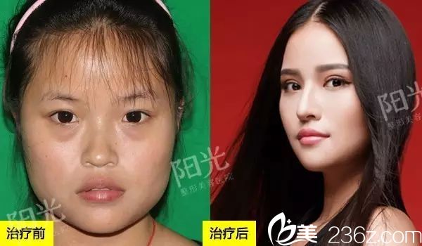 <!--<i data=20240703-sp></i>-->整形醫(yī)院雙眼皮隆鼻和下頜角整形案例圖 <!--<i data=20240703-sp></i>-->整形醫(yī)院雙眼皮隆鼻和下頜角整形案例圖