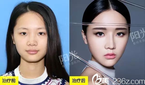 <!--<i data=20240703-sp></i>-->整形醫(yī)院隆鼻和自體脂肪全臉填充案例圖 <!--<i data=20240703-sp></i>-->整形醫(yī)院隆鼻和自體脂肪全臉填充案例圖