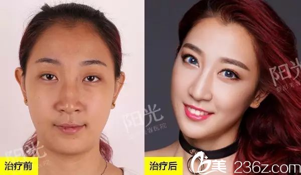 <!--<i data=20240703-sp></i>-->整形醫(yī)院雙眼皮隆鼻案例對比圖 <!--<i data=20240703-sp></i>-->整形醫(yī)院雙眼皮隆鼻案例對比圖