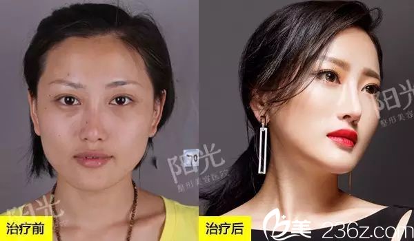 <!--<i data=20240703-sp></i>-->整形醫(yī)院雙眼皮和脂肪填充效果圖 <!--<i data=20240703-sp></i>-->整形醫(yī)院雙眼皮和脂肪填充效果圖