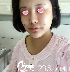 金秋燕面部脂肪填充案例術(shù)后4天樣子