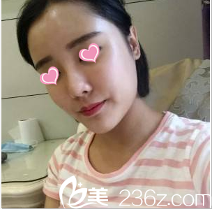 <!--<i data=20240703-sp></i>-->自體脂肪面部填充案例術(shù)后第28天效果