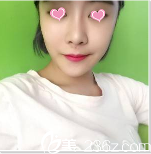 聊聊我在醫(yī)院找金秋燕做面部脂肪填充經(jīng)歷朋友說(shuō)效果自然美觀