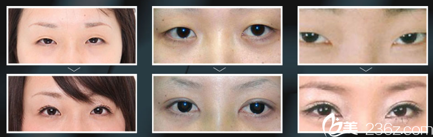 孫華剛眼綜合整形案例 孫華剛眼綜合整形案例