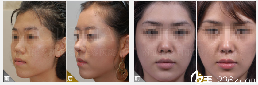 張文琪隆鼻案例 張文琪隆鼻案例