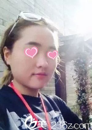 <!--<i data=20240703-sp></i>-->整形醫(yī)院隆鼻案例 <!--<i data=20240703-sp></i>-->整形醫(yī)院隆鼻案例