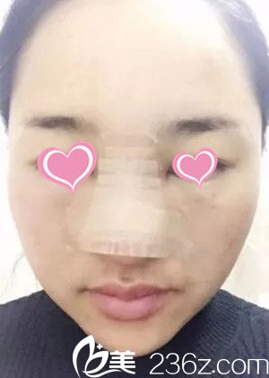 史希杰院長隆鼻手術案例分享 史希杰院長隆鼻手術案例分享