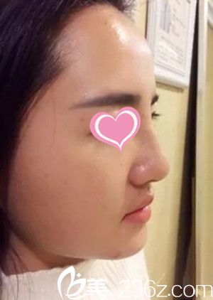 隆鼻后7天 隆鼻后7天