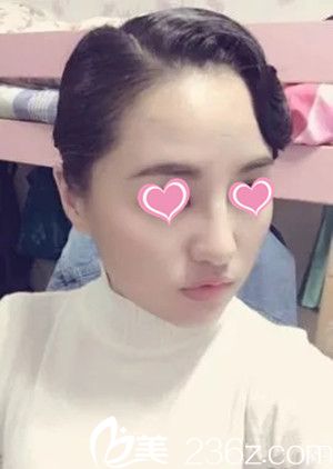 隆鼻后一個月恢復效果 隆鼻后一個月恢復效果