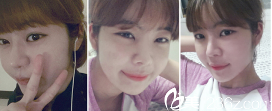 這是恢復(fù)了一個月后的樣子