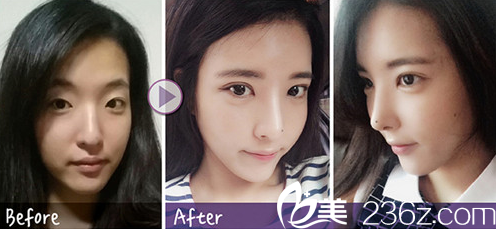 一個月后朋友說我的鼻子像一個明星，我也不怎么看美劇