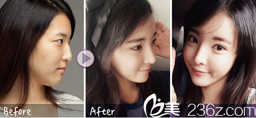 整容后的我真的年輕了好多歲啊