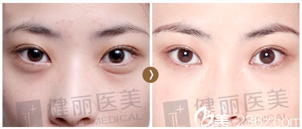 深圳健麗醫(yī)美20歲不開刀祛眼袋效果 深圳健麗醫(yī)美20歲不開刀祛眼袋效果