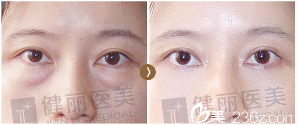 深圳健麗醫(yī)療美容醫(yī)院30歲不開刀祛眼袋效果 深圳健麗醫(yī)療美容醫(yī)院30歲不開刀祛眼袋效果