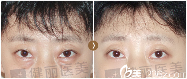 深圳健麗醫(yī)美40歲祛眼袋效果 深圳健麗醫(yī)美40歲祛眼袋效果