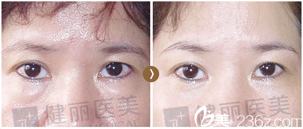 深圳健麗醫(yī)美45歲祛眼袋效果 深圳健麗醫(yī)美45歲祛眼袋效果