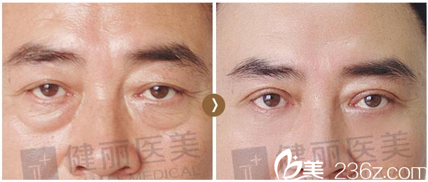 深圳健麗醫(yī)療美容醫(yī)院50歲祛眼袋效果圖 深圳健麗醫(yī)療美容醫(yī)院50歲祛眼袋效果圖