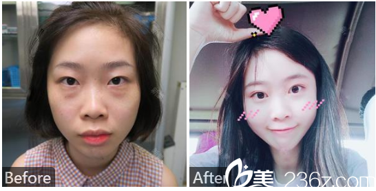 深圳健麗醫(yī)療美容醫(yī)院陳雪濤不開刀雙眼皮和不開刀祛眼袋案例圖 深圳健麗醫(yī)療美容醫(yī)院陳雪濤不開刀雙眼皮和不開刀祛眼袋案例圖