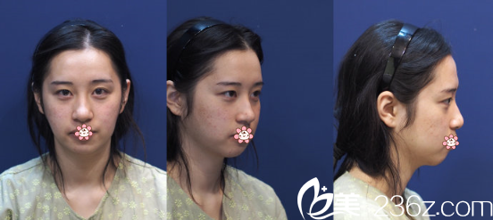 去韓國KIWI整形外科面診的我 去韓國KIWI整形外科面診的我