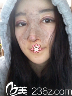 金智勛雙眼皮假體隆鼻術(shù)后6天 金智勛雙眼皮假體隆鼻術(shù)后6天