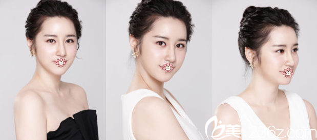 去了韓國(guó)KIWI整形金智勛那兒做雙眼皮假體隆鼻和自體脂肪全臉填充其實(shí)是羨慕朋友整完的好效果