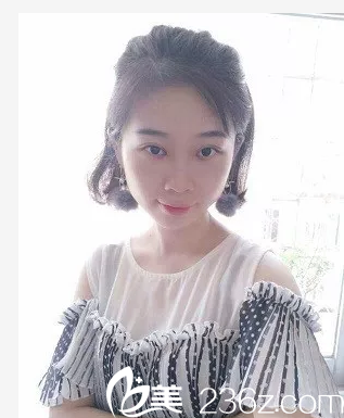 去深圳健麗醫(yī)美做完不開刀祛眼袋和雙眼皮五天了 去深圳健麗醫(yī)美做完不開刀祛眼袋和雙眼皮五天了