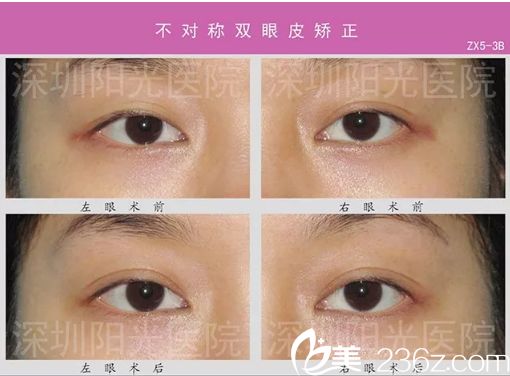 <!--<i data=20240703-sp></i>-->整形醫(yī)院雙眼皮不對(duì)稱(chēng)失敗修復(fù)案例 <!--<i data=20240703-sp></i>-->整形醫(yī)院雙眼皮不對(duì)稱(chēng)失敗修復(fù)案例