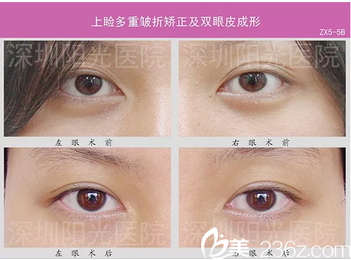 <!--<i data=20240703-sp></i>-->整形醫(yī)院多層雙眼皮失敗修復(fù)案例 <!--<i data=20240703-sp></i>-->整形醫(yī)院多層雙眼皮失敗修復(fù)案例