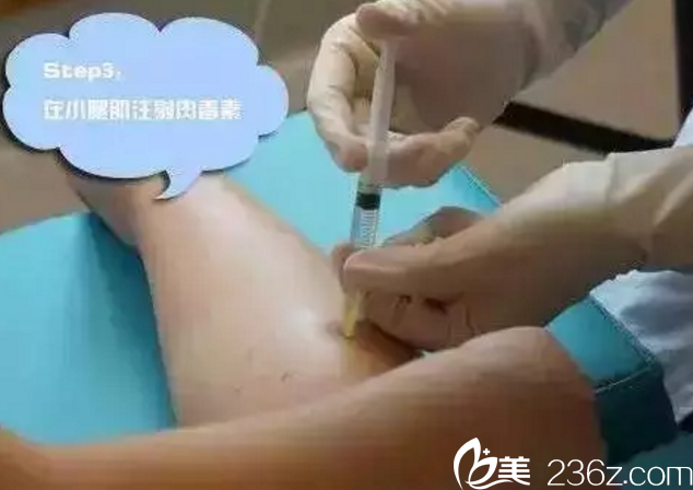 注射瘦腿過程 注射瘦腿過程