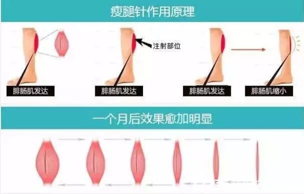 瘦臉除皺瘦腿作用原理 瘦臉除皺瘦腿作用原理