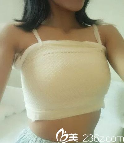 張維華醫(yī)生假體隆胸手術(shù)案例