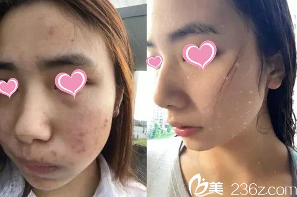 <i data-id='f9756438-1d8e-4993-b3cb-c2a2468b6b6f' style='display:none;'></i>整形醫(yī)院祛痘案例對比效果 <i data-id='f9756438-1d8e-4993-b3cb-c2a2468b6b6f' style='display:none;'></i>整形醫(yī)院祛痘案例對比效果