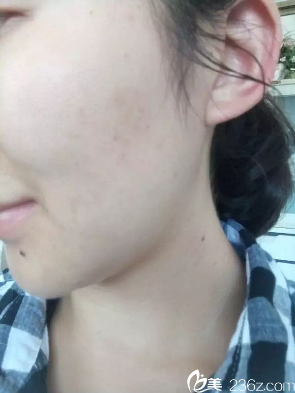在整形醫(yī)院終于把我煩惱了多年的痘痘治好了，超級開心