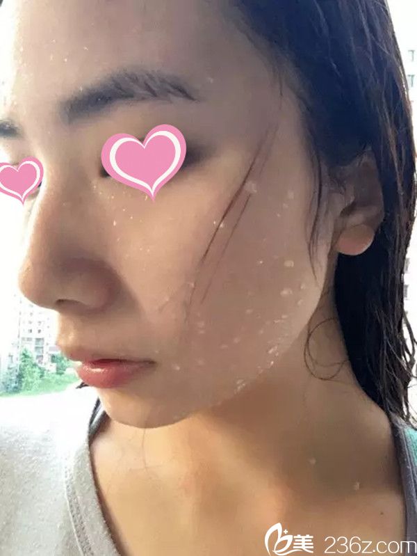 在<i data-id='f9756438-1d8e-4993-b3cb-c2a2468b6b6f' style='display:none;'></i>整形醫(yī)院祛痘后效果 在<i data-id='f9756438-1d8e-4993-b3cb-c2a2468b6b6f' style='display:none;'></i>整形醫(yī)院祛痘后效果