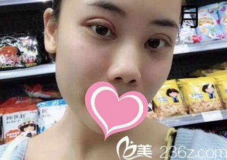 在濮陽張大夫整形做雙眼皮和開眼角術(shù)后6天 在濮陽張大夫整形做雙眼皮和開眼角術(shù)后6天