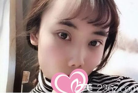 濮陽(yáng)張大夫整形做全切雙眼皮+無痕開眼角 效果贊不贊看我手術(shù)前后照片